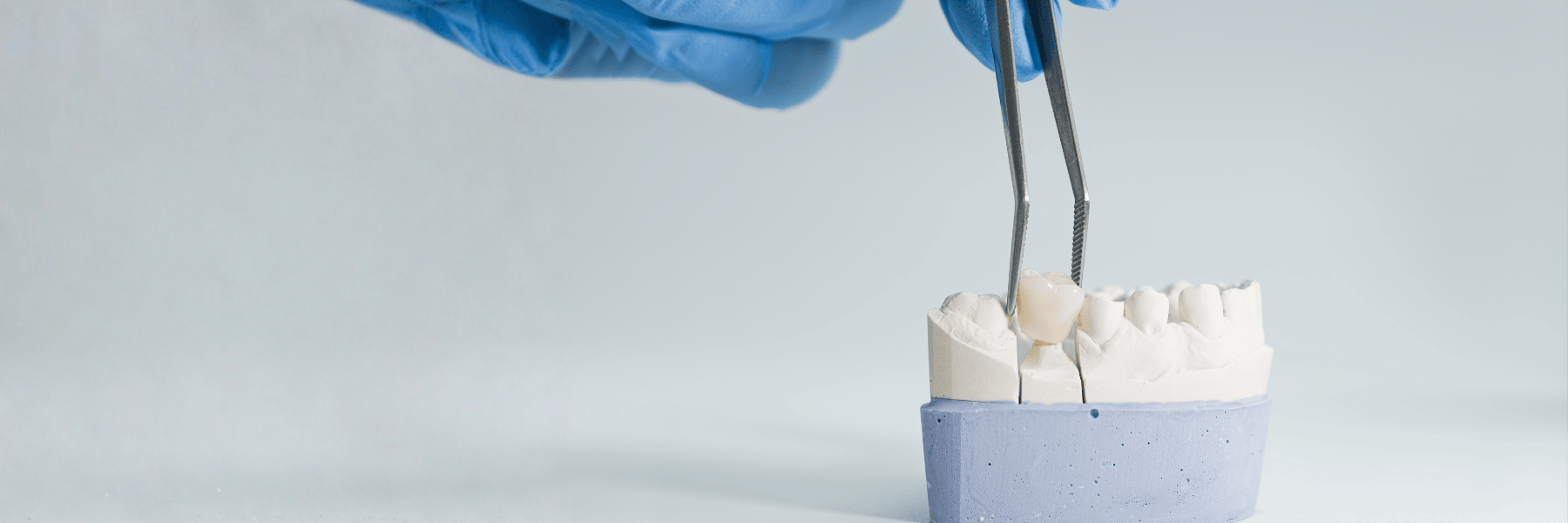 CEREC® Crowns and Bridges | Dentist